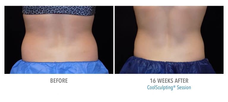 Before and After CoolSculpting