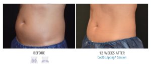 compliment a home work out routine with coolsculpting compliment a home work out routine with coolsculpting